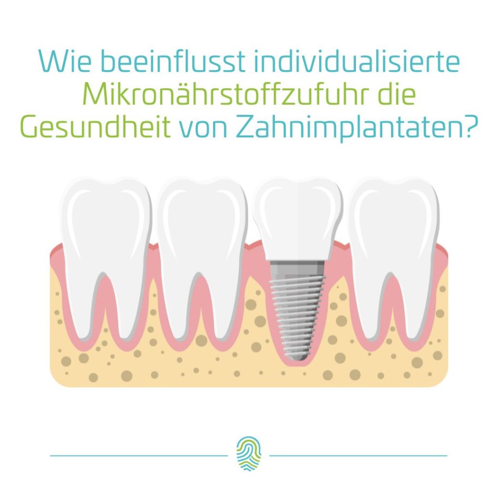Gesundheit von Zahnimplantaten fördern mit Mikronährstoffen